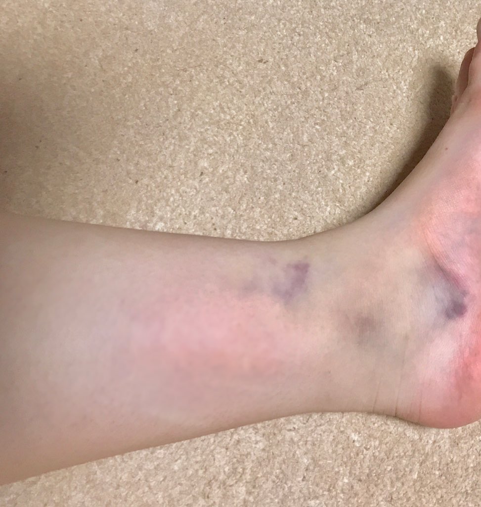 ぶつけ て ない の に あざ