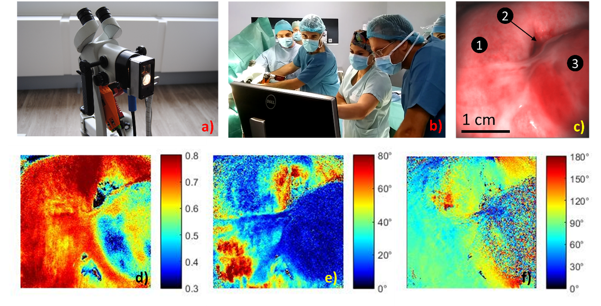 CNRSingenierie's tweet photo. Réalisation des premières images polarimétriques de Mueller du col utérin in vivo en bloc opératoire https://t.co/zHnEFo4a1z #LPICM https://t.co/EgbhidBIUD