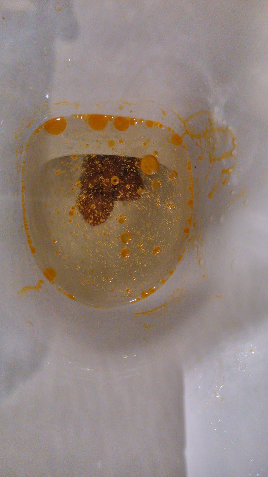 Pedgastro On X: #Keriorrhea #diarrea #PedsGI X, 48% OFF