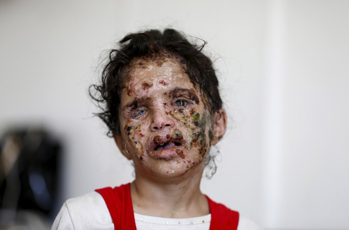 wikileaks's tweet image. While western feminists complain about Trump revealing Brzezinski's facelift here is what US bombs have been doing to girls' faces in Yemen.