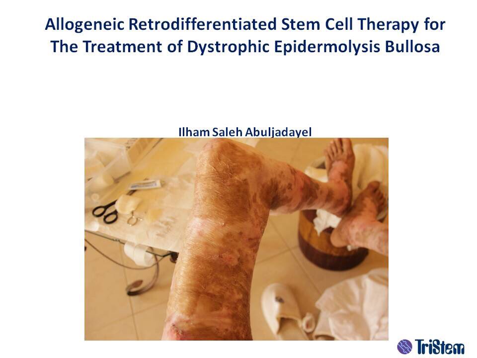 ilhamabuljadaye's tweet photo. My second talk today on the use of #stemcell for treatment of EBD #RareDisease conference #London #RegenerativeMedicine #الخلايا_الجذعيه https://t.co/DdPefkTUWd