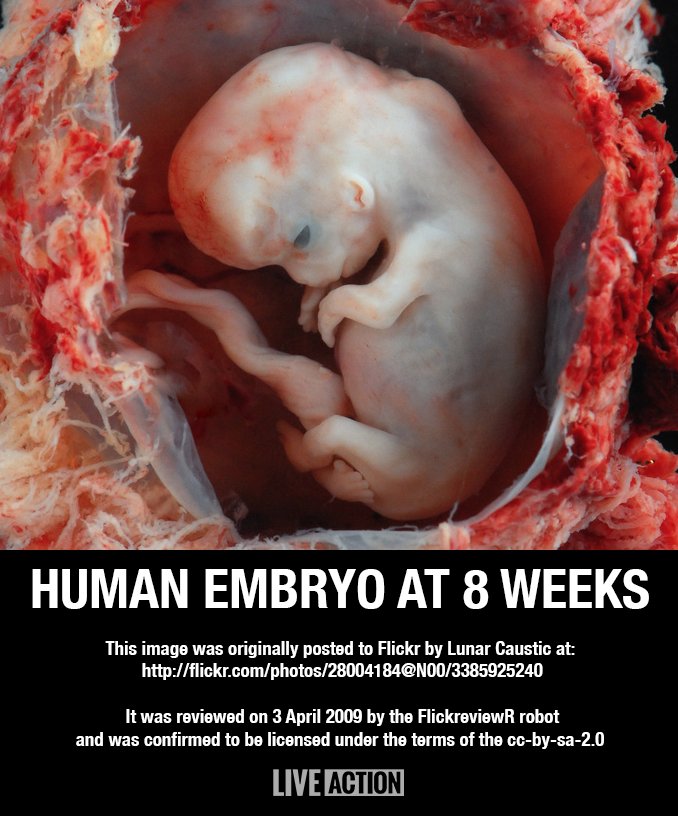 LiveAction's tweet photo. Not a "potential" human life — a human life with potential. #prolife #endabortion https://t.co/oro0sYzo6o