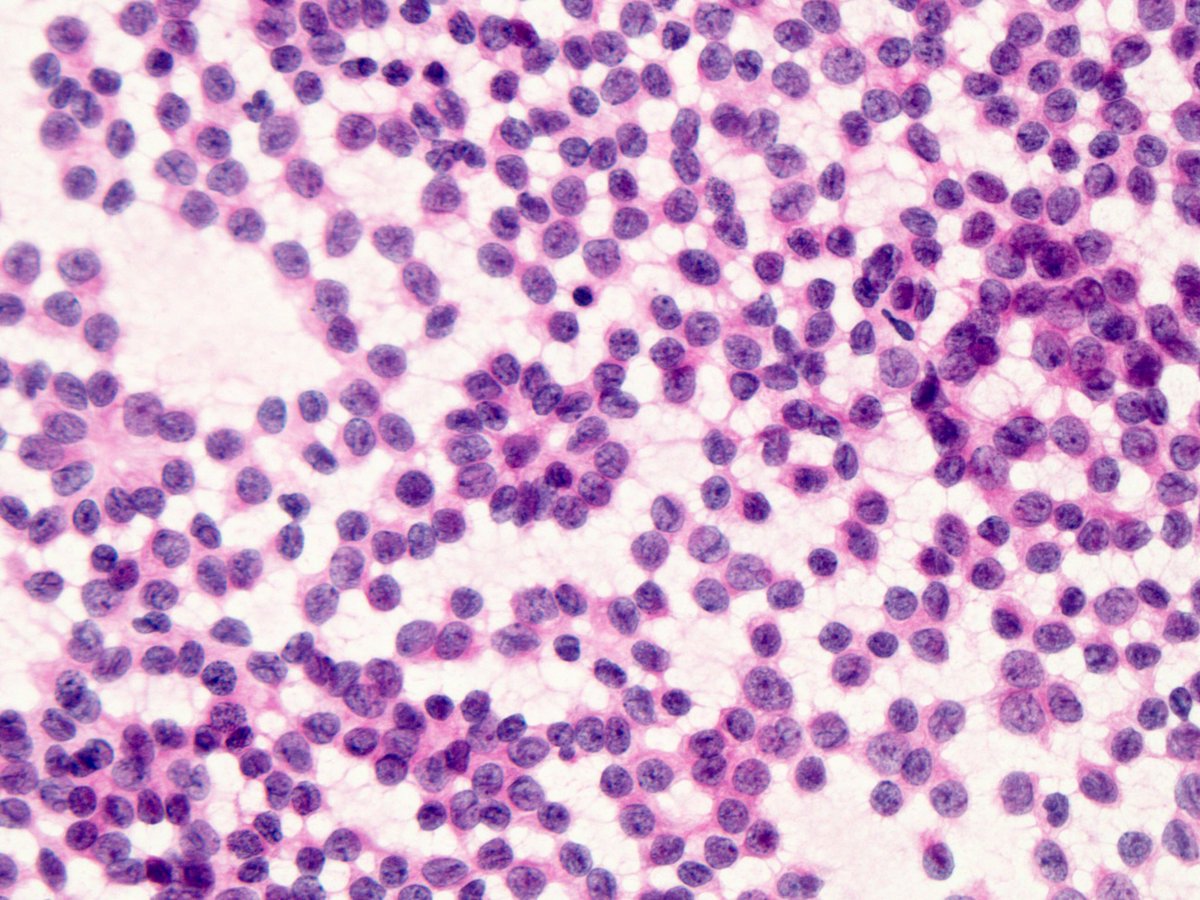 Granulosa cell tumor. Scrape made from mass at frozen section 

#gynpath #cytopath <a href="/Missle/">Missle</a> <a href="/GynPath/">GYN Pathology</a> @yasminelys <a href="/pembeoltulu/">Pembe Oltulu, MD</a> <a href="/mvmd0908/">Pathology</a>