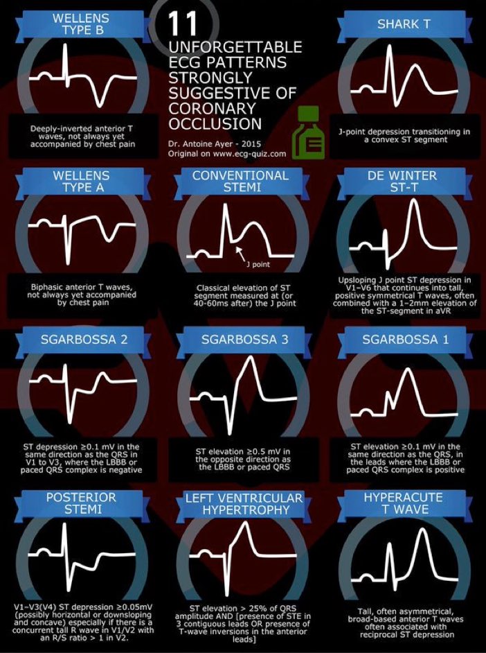 1. If you rely only on "STEMI Criteria" you'll miss many Coronary Occlusions
2. Look for #ECG Patterns!

#FOAMed