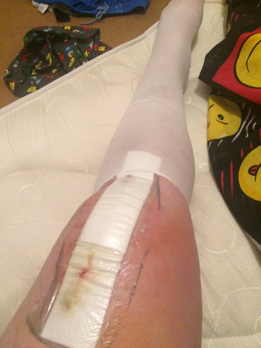 ProphecyJoel's tweet photo. It sucks but this is my second knee surgery in two years, but like @WWERollins I'm gonna redesign and rebuild to be the best I can be! https://t.co/1UMG0BMCLn