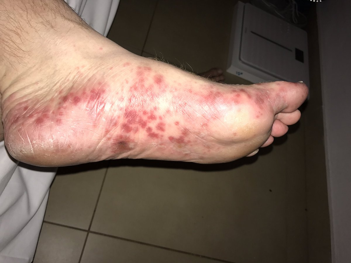Having a holiday from hell <a href="/AtlanticaGroup/">Atlantica Hotels</a> #aeneasresort <a href="/ThomsonHolidays/">TUI UK</a> stuck in are room with hand foot and mouth. #gutted