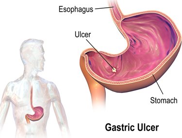 EU_HomeRemedies's tweet photo. European Natural Remedies For Ulcers 
#naturalhealing #healthyliving #natura ... https://t.co/N8BmI9MUKN https://t.co/rYUj8rlfnM