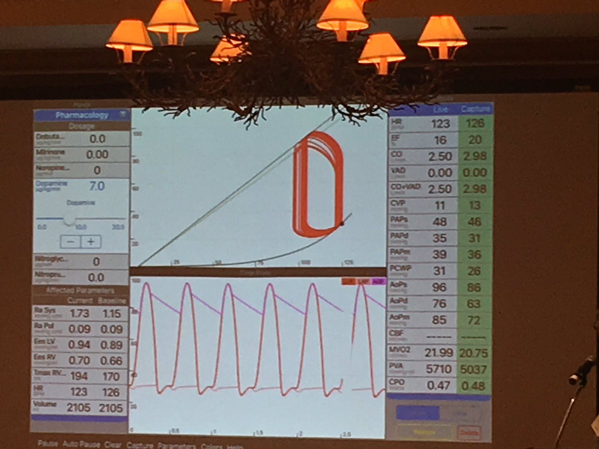_mikeward's tweet photo. Dr. Marc Dickstein using HARVi to sim treating CGS patient. Don't increase pressure at the expense of flow. Unload the LV. #hartzlerics https://t.co/tDwkVw3CVG