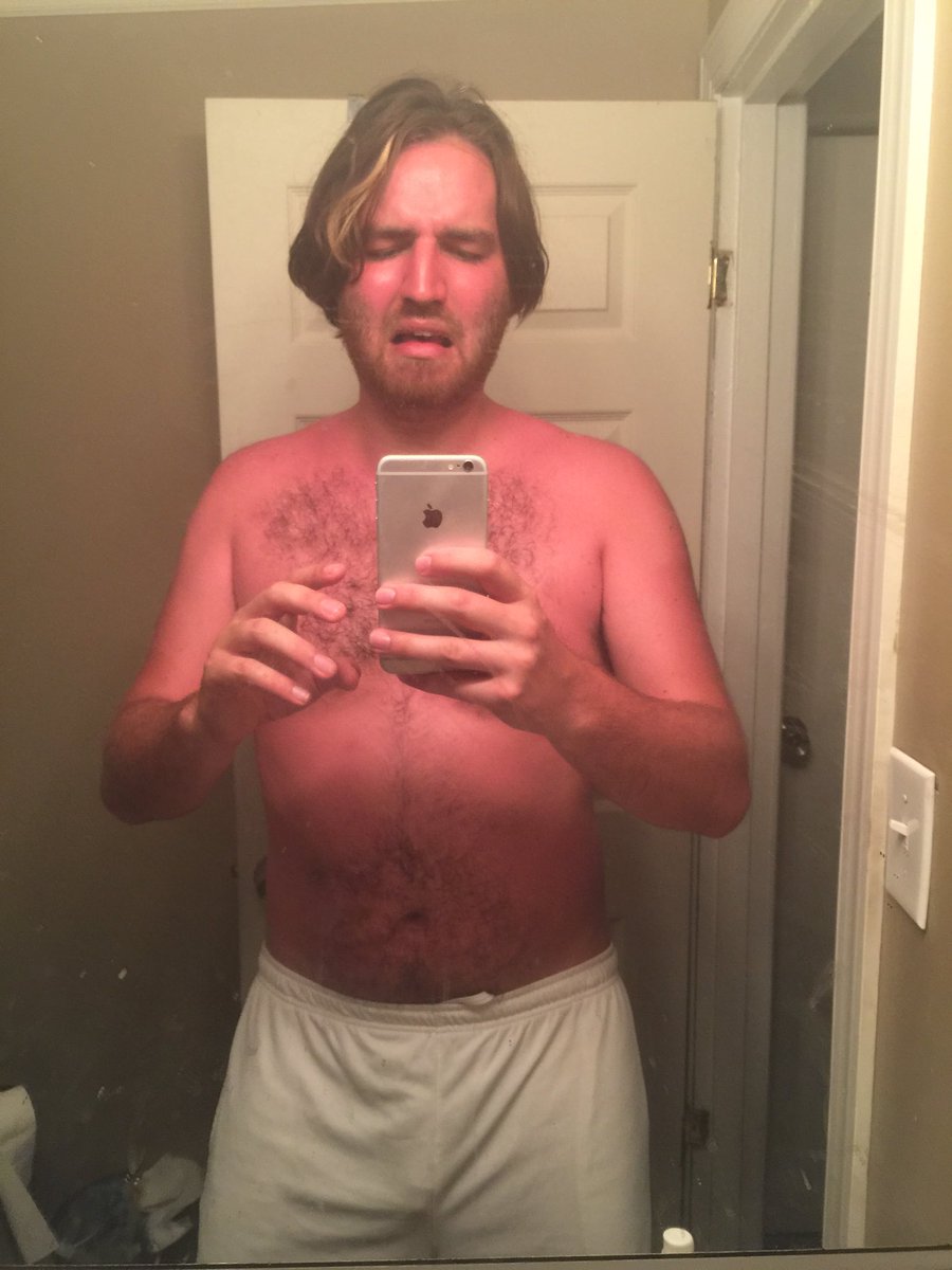 EthanSamuel's tweet photo. My current sun burn pales in comparison to 2015s. #NeverForget #spfinfinity https://t.co/gTJwEr2tvf