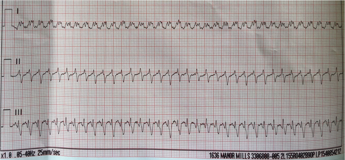 smithECGBlog's tweet photo. Wide complex tachycardia at a rate of 270  https://t.co/G5yzjLA15f https://t.co/jegVVLrve7