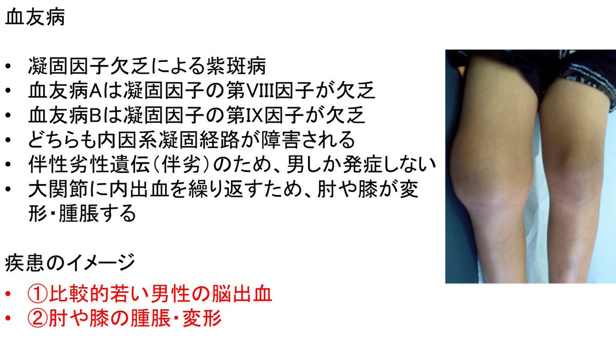 血液・免疫疾患５ 血友病は内因系凝固経路が障害される紫斑病。外因系凝固経路に障害はない。状況設定問題では、①比較的若い男性の脳出血、②肘や膝の腫脹・変形  として出題される。選択肢は出血を伴う処置は選ばないようにすること。