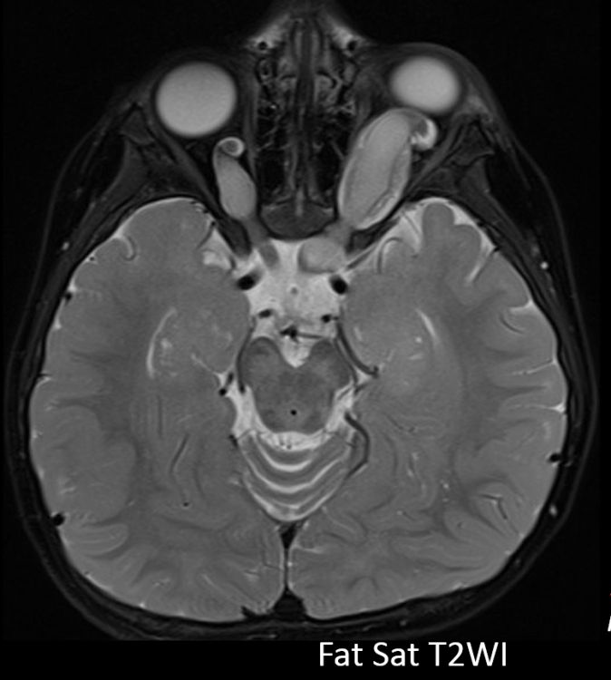 A 3-year-old girl with left eye proptosis bit.ly/CC-2017Jul17