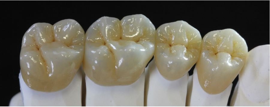 iCrownStudio's tweet image. Posterior Direct serving IOS Doctors "Instant Rebate" @Chicago_Dental #posterior #anterior #3unitbridge #icrown #icrownstudio