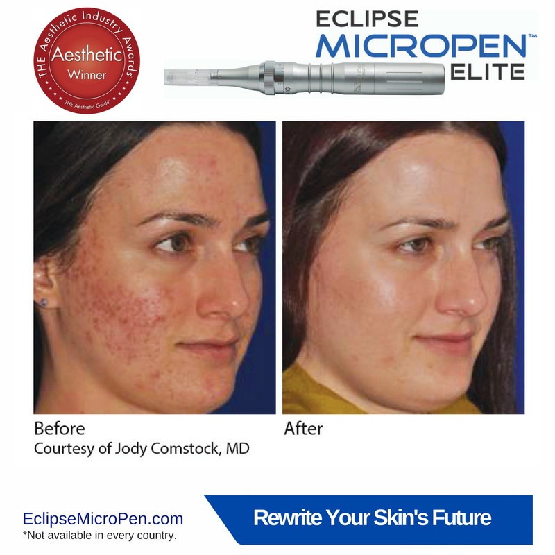 EclipseMicroPen's tweet photo. Give yourself the gift of healthier skin this #holiday season. Ask about #EclipseMicroPen. https://t.co/8F2FgqBoFm