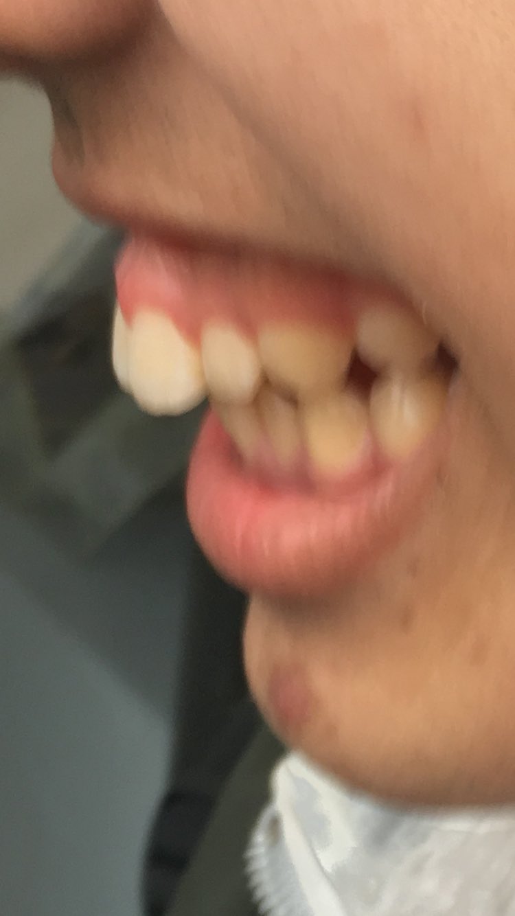 تويتر 大西ともや على تويتر 豊田の歯茎の写真はみんな一枚は保存してる説 なぜ歯茎の写真がこんなにもあるのか 学校の七不思議 トゥサンルヴェルチュール 世に出回りすぎではないのか T Co Mez1nid7ww