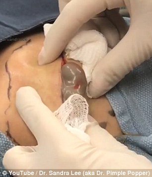Daily_MailUS's tweet photo. Revolting moment Dr Pimple Popper squeezes thick grey pus from a 50 YEAR OLD cyst https://t.co/2aNEYxw2xv https://t.co/Po8T8tVfpQ