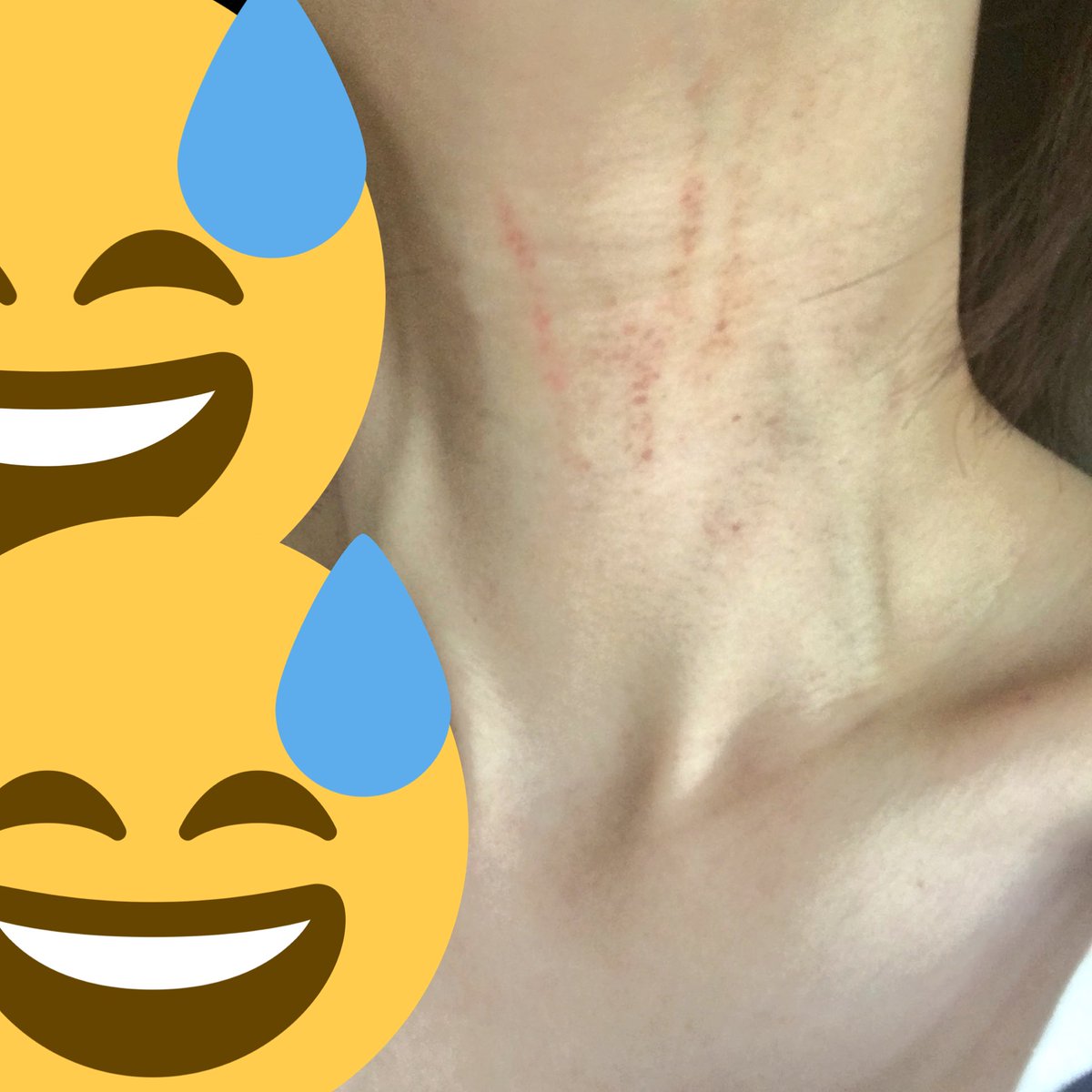 Di Twitter Dvみがすごい 大きいあざも膝上にあるし 腕は擦り傷があるし Dvって言ったら割と本気で父親に心配された 冗談だよ 太陽アレルギーなのか陽射しの下にいると首だけ赤くなってしまう 去年もそうだった えぐい T