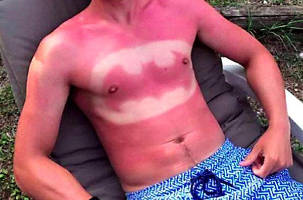 guardiacivil's tweet photo. A lo de ir "colorao como una gamba" algunos lo han llamado #sunburnart pero sigue siendo igual de peligroso (aunque con un nombre más cool)

No juegues con tu salud https://t.co/yXgBsu0tIk