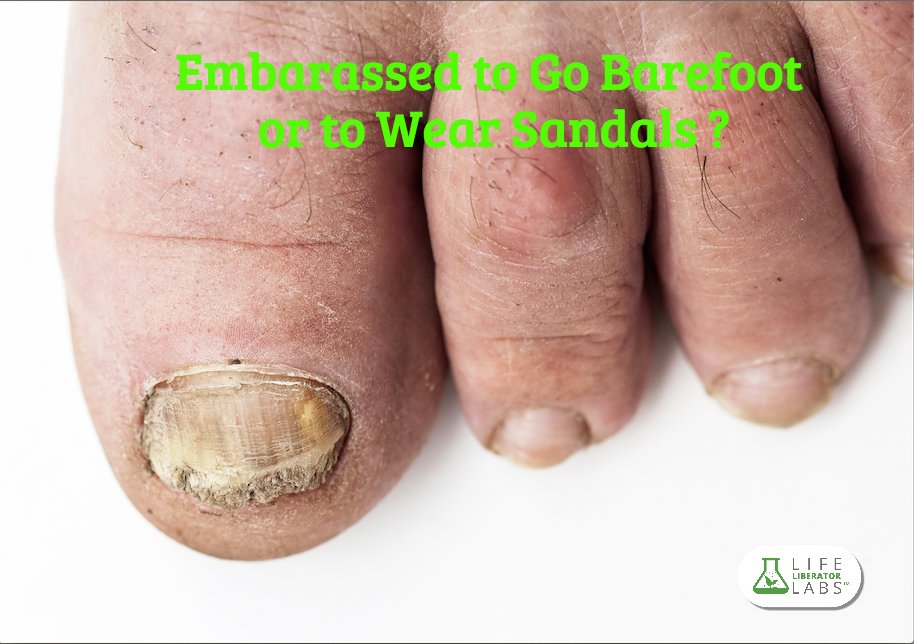 LifeLibLabs's tweet photo. We feel you! Toe nail fungus is embarrassing. Not to worry, #DigestLiberate @lifeliblabs can help you. https://t.co/EfEAuhXQtd