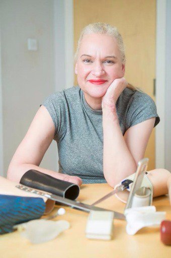 Linsay lost a hand and both her feet to meningitis but is determined to go back to work. bit.ly/2tknmqc