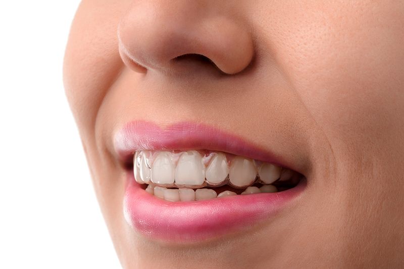 WillowPasDental's tweet photo. Invisalign: Clear Braces, Clear Smile, Clear Benefits https://t.co/fz76NHCWIS #braces #bestdentistinconcord #orthodontics #willowpass https://t.co/m9hAOUpzMr