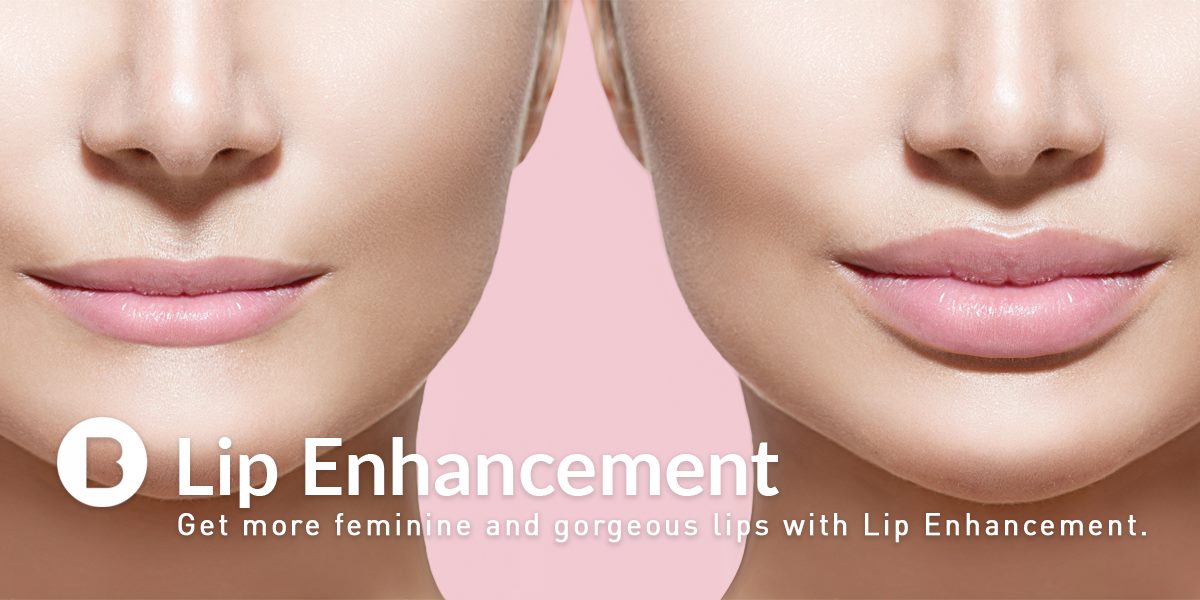 Do you wish you had fuller lips? A simple 30 to 60 minute treatment can transform your lips into the perfect shape. bit.ly/1XXMSHZ