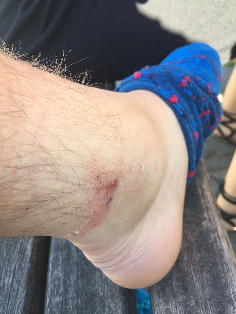 1st injury of the season.    Nasty scratch should keep him out for 6 months.