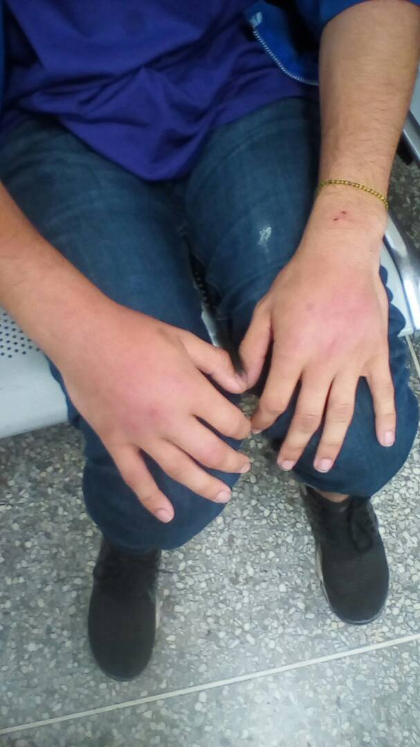 joseantonetti's tweet photo. Esas son las manos de Anthony, niño de 15 años.  Compañero de beisbol de mi hijo. Golpeado por la GN por el delito de caminar por Chacaito. https://t.co/CiCASFAEfy