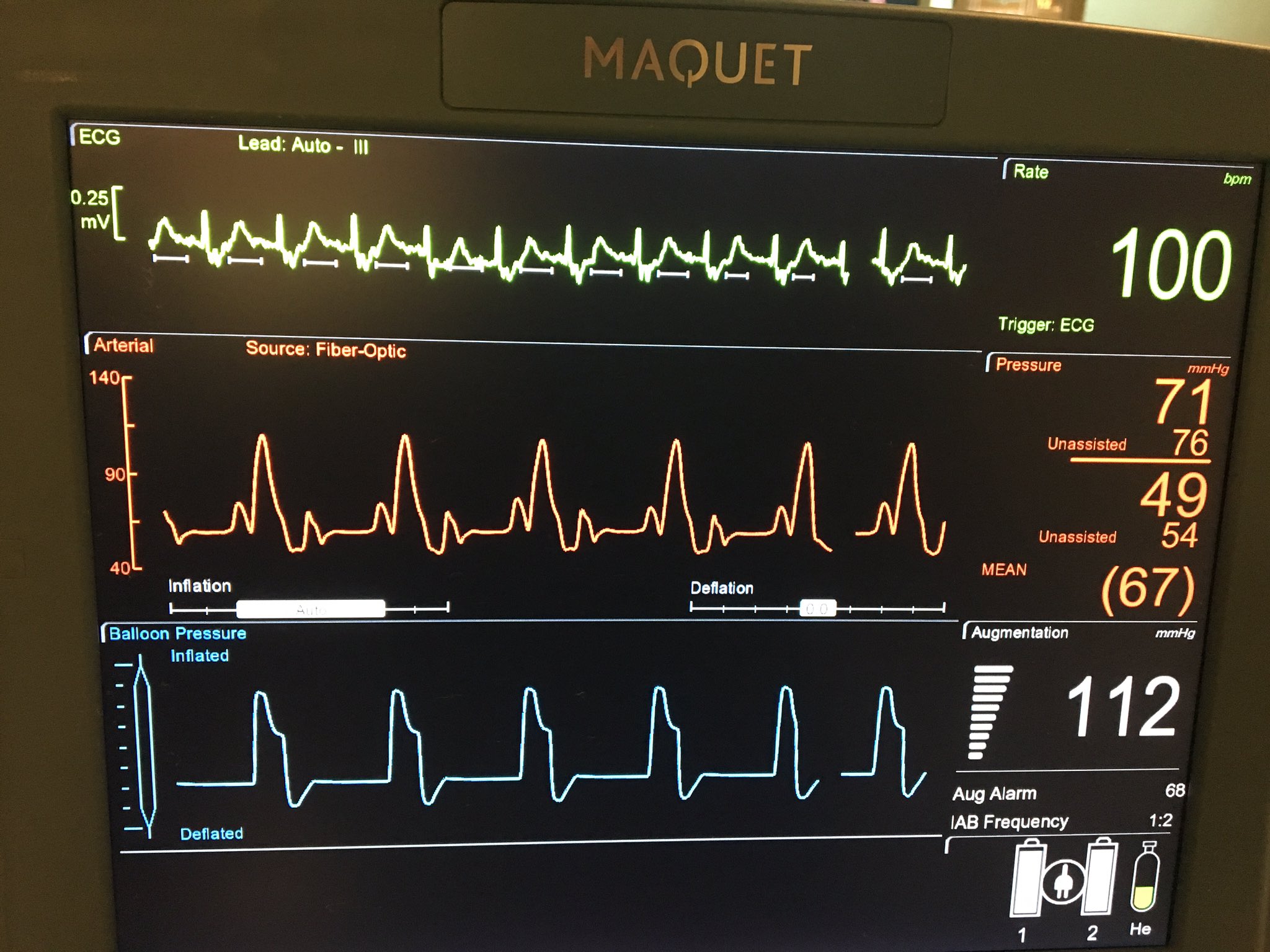 Oren friedman on twitter the degree of diastolic augmentation with