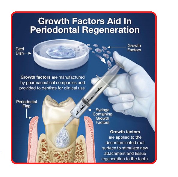 Flap SurgeryWhat Is It?Gingival flap surgery is a ..For more info visit... chandanorthodonticssuperspeciality.com/bizFloat/59631…