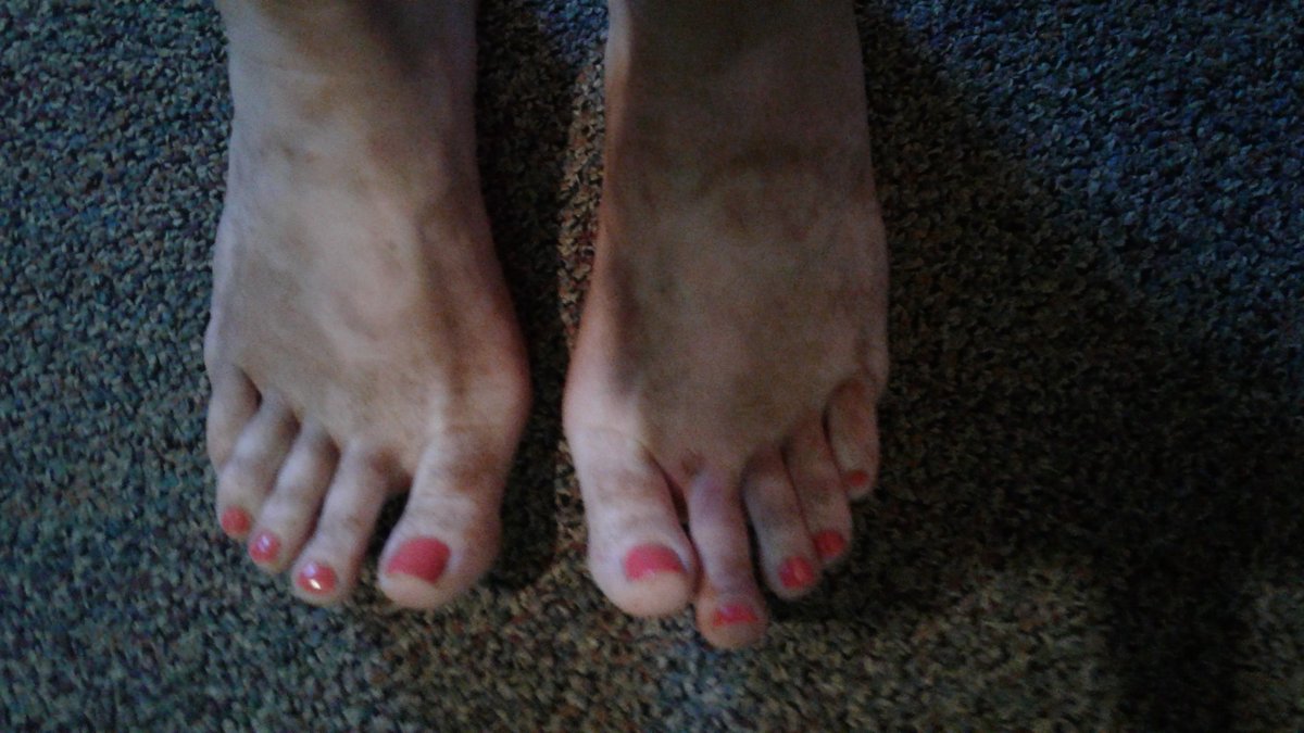 PureCountry1035's tweet photo. I know, my feet R disgusting! What can I say? I'm a true summer concert gal! Anyone else take home red PEI sand? #BrentandDeb #Cavendish2017 https://t.co/yY5uiLjute