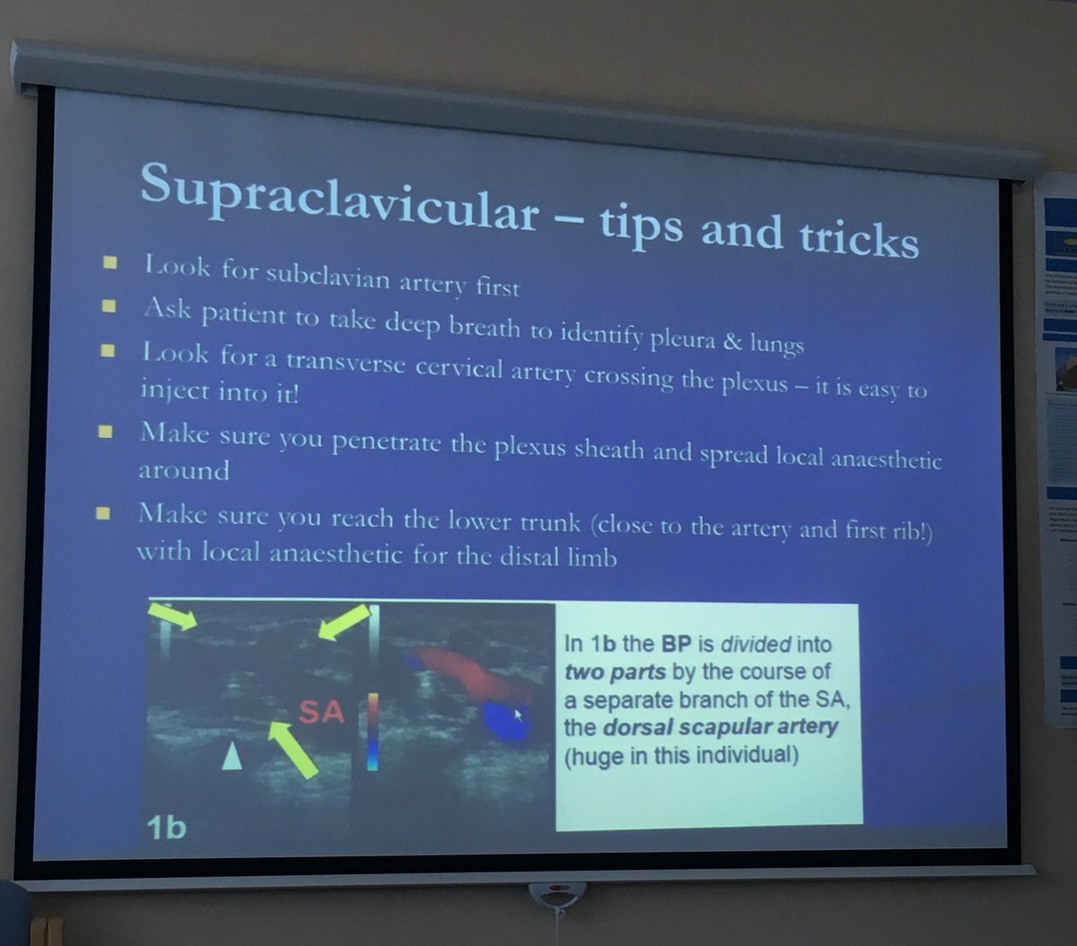 surfindoc's tweet photo. Tips &amp; tricks for supraclavicular block courtesy of Dr Fidel Bayshev, look out for the transverse cervical artery #regionalanaesthesia https://t.co/bfW59QTWz8