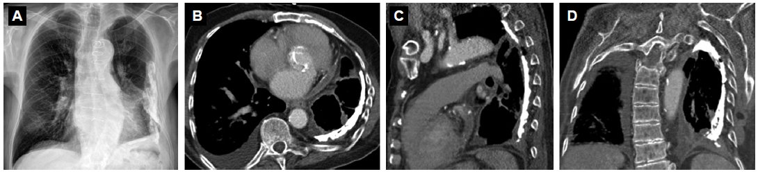 #COTW 82yr man w/ coronary artery disease &amp; hypertension - suspected exacerbation of congestive heart failure arrs.org/caseoftheweek