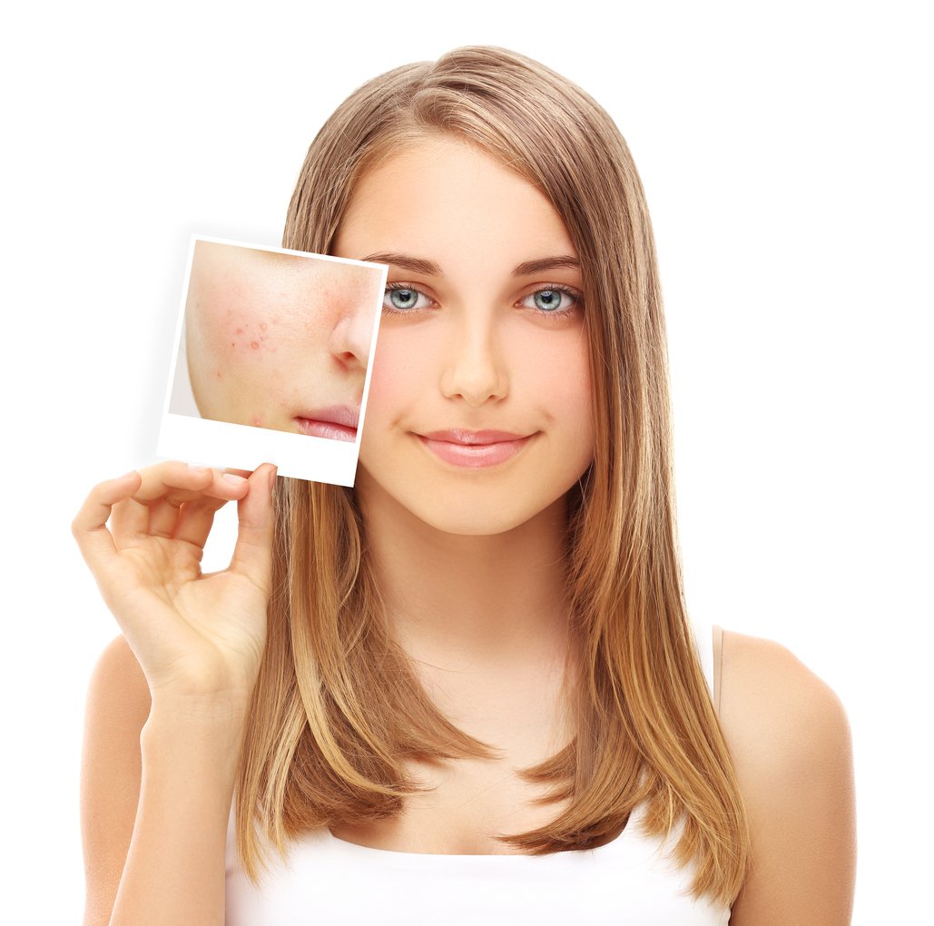 Issues with acne? Treatments are always individual, but we’ve got some great solutions. Give us a call on 023 80760380. #skincare #acne