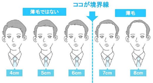 ゆなこ 先月の水曜日のダウンタウンで インポッシブル蛭川以上に額が狭い人など この世にいない説 やってたよ 額の長さ 眉 から生え際 は日本人は平均6cmらしい 因みに蛭川さんは2 5cm