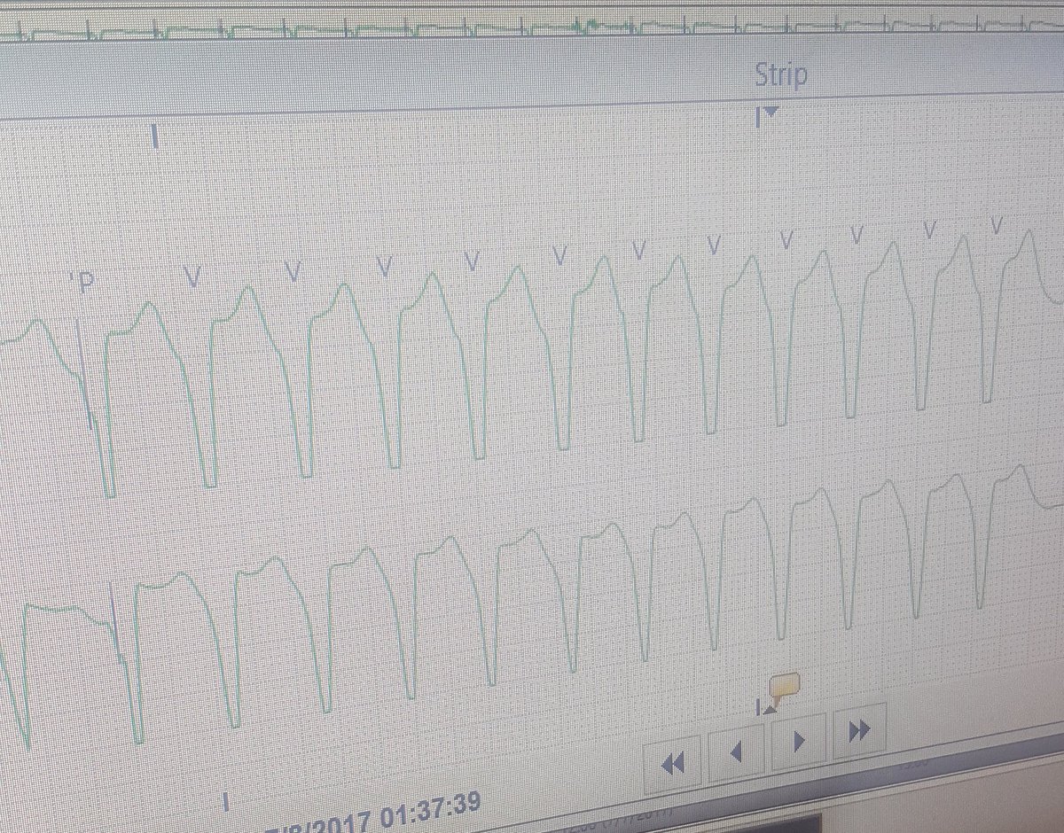 nurse_face's tweet image. OBS admit for CP, trop in ED &amp;lt;0.05 &amp;amp; work up unremarkable ⏩FF 5 hrs... NO CP but a trop of 30.0 &amp;amp; this #vtach #legit #pleasedontcode 🤔😲
