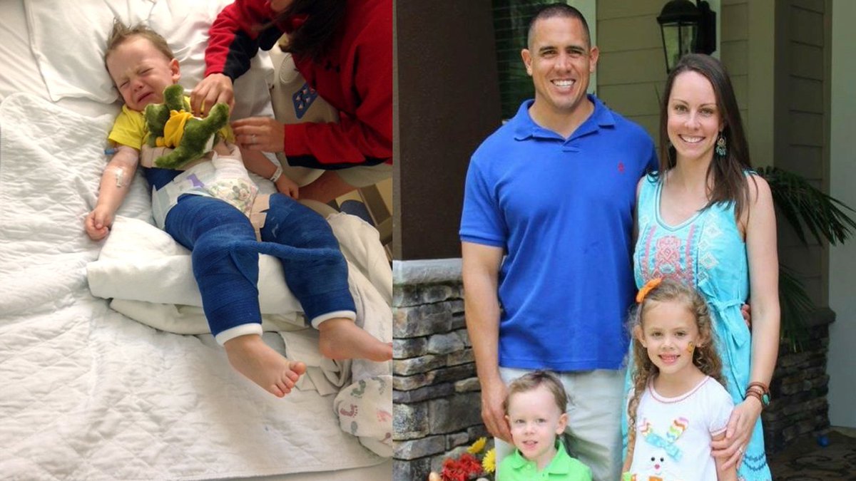 Florida boy, 3, in body cast for jumping on trampoline bit.ly/2uQy4Dg https://t.co/4AxEn7qKxJ
