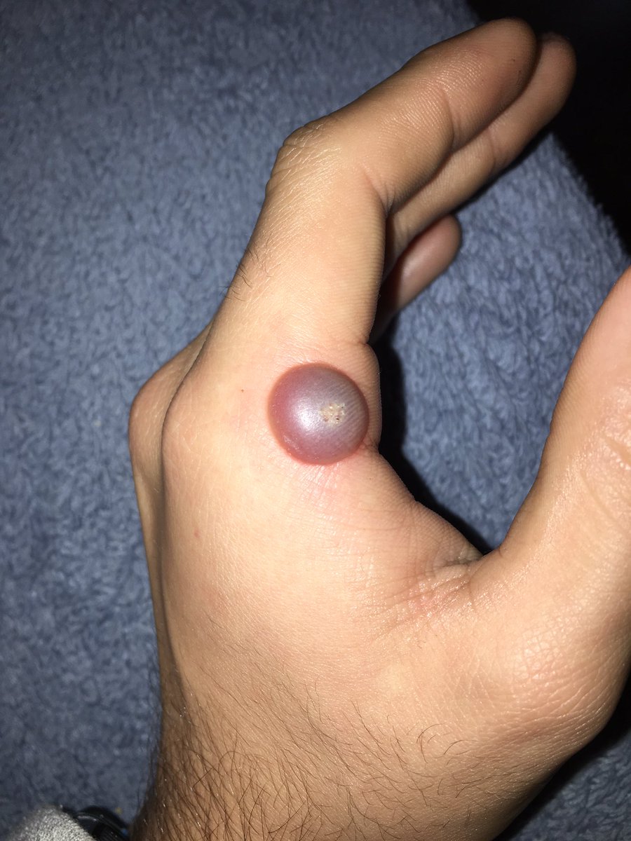 Rt o te van a salir en la cara