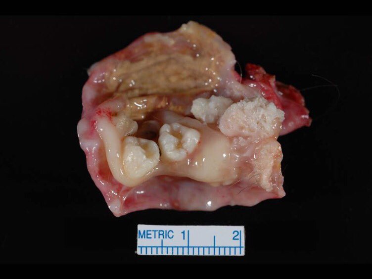 Sanjay Mukhopadhyay (@smlungpathguy) on Twitter photo What does pluripotent mean? I will let the image speak for itself
A special post for my old friend <a href="/AsgharNaqvi9/">Asghar Naqvi</a> #grosspath #pathology What does pluripotent mean? I will let the image speak for itself
A special post for my old friend <a href="/AsgharNaqvi9/">Asghar Naqvi</a> #grosspath #pathology