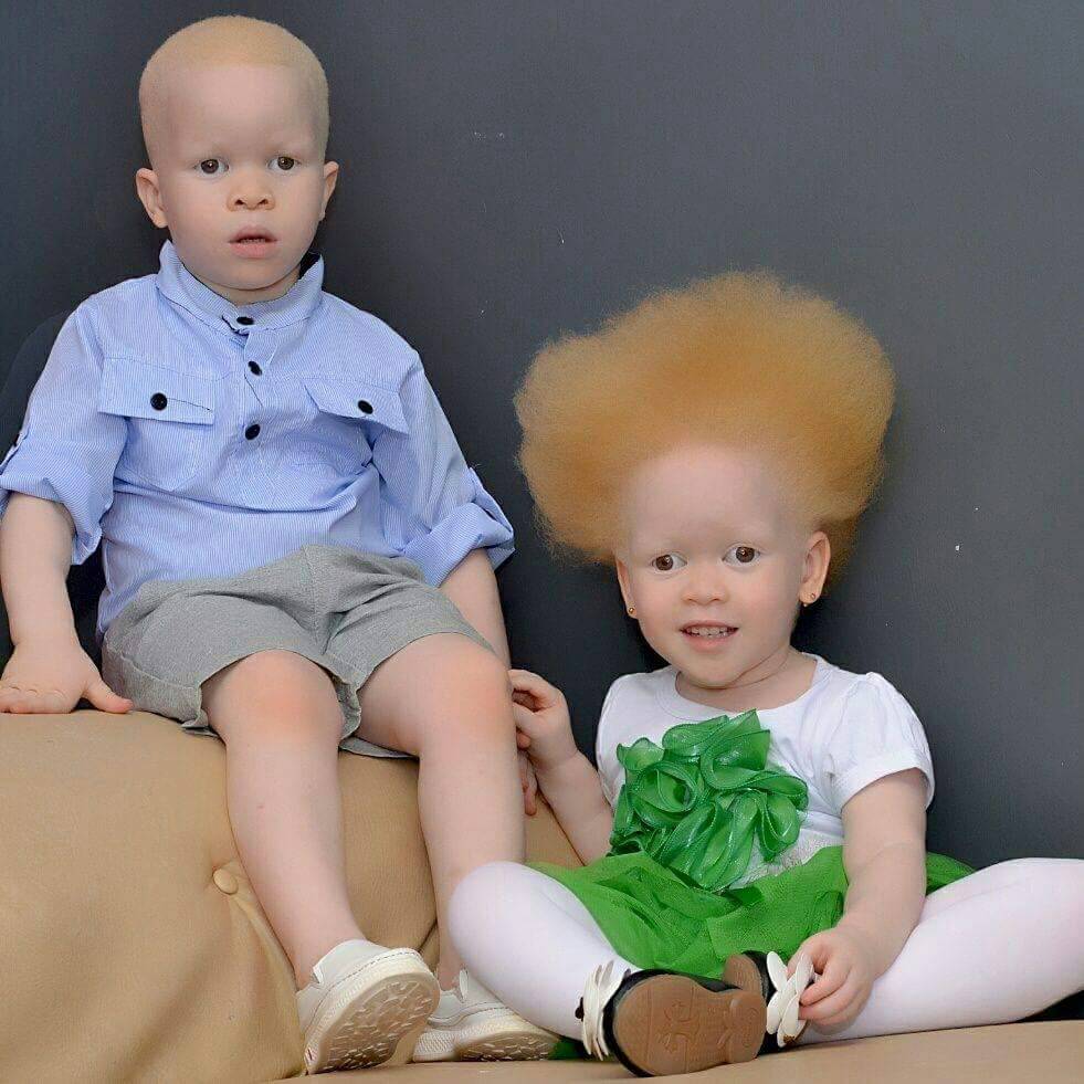 HappyMmila's tweet image. Albinism is just a condition #STOPSTIGMAEMBRACEALBINISM @SNUPA6 @adduk @OgikPeter @UN