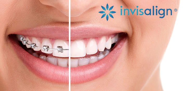 LpoolDentalSpa's tweet photo. 6 month smiles at Liverpool Dental Spa will straighten your teeth out in considerably less time than a normal brace, call 0151 236 8280 now📞 https://t.co/aWVqiOvCqq