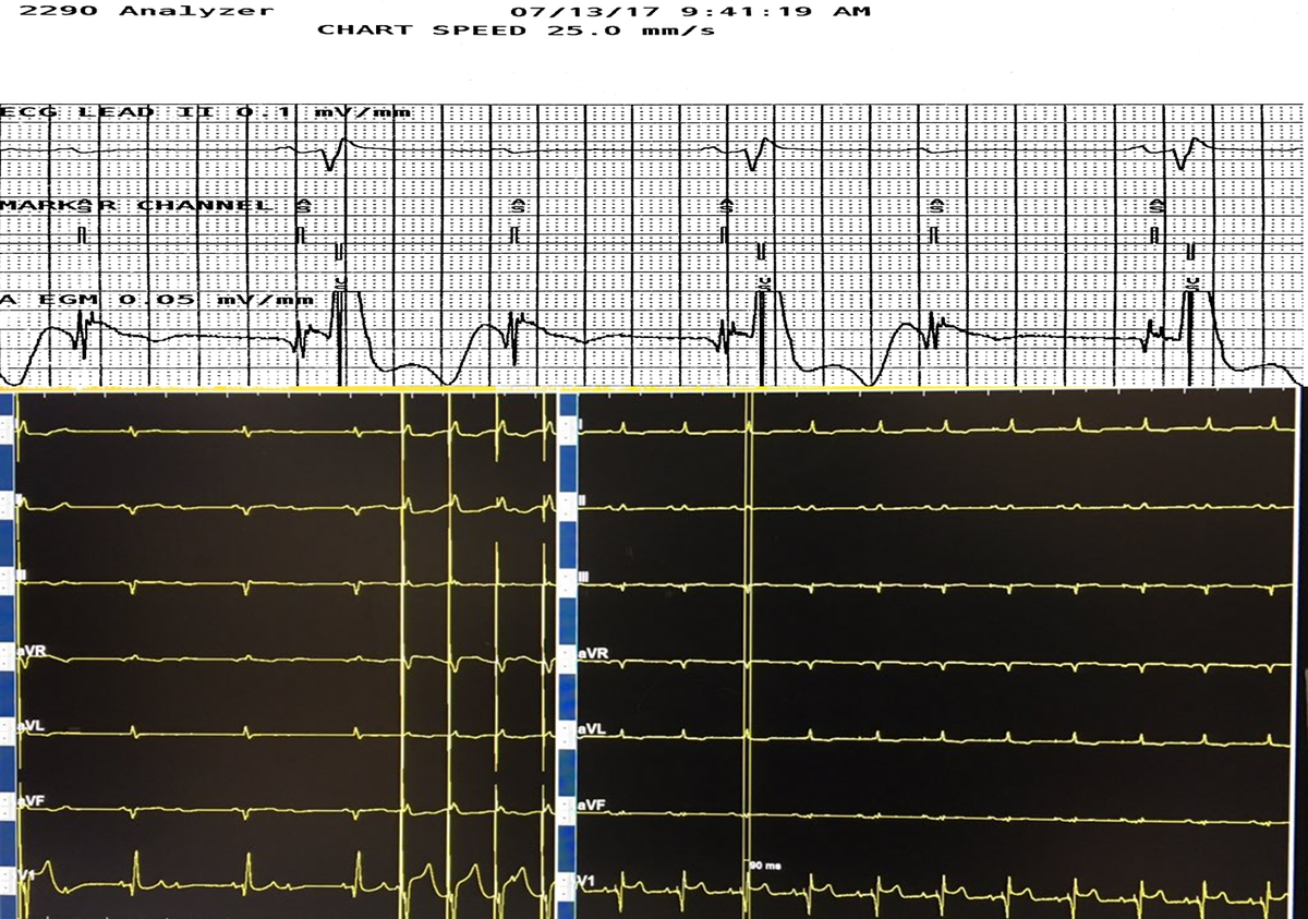 Today #dontdisthehis. More His purkinje recruitment bipolar versus unipolar with infra-His block @gopi_gdanda1