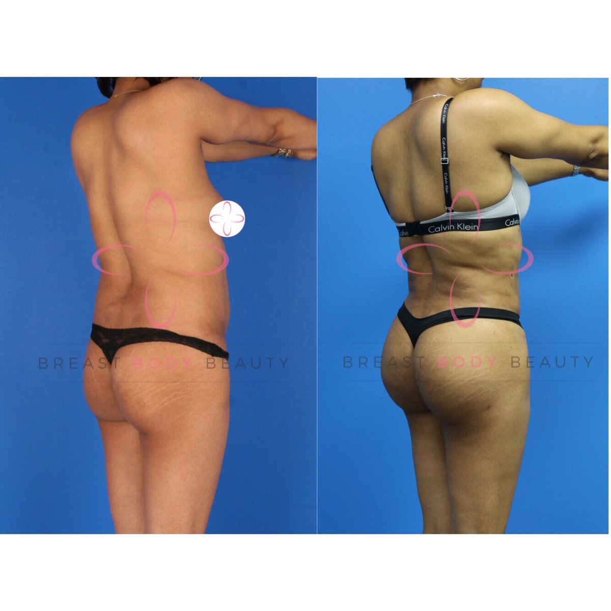 BreastnBodyDoc's tweet photo. Natural but noticeable results. 10 months after #BBL #BrazilianButtLift ๐
#BreastBodyBeauty #DrAishaBaron #PlasticSurgery #BodyByBaron https://t.co/JKPtVCBr3U