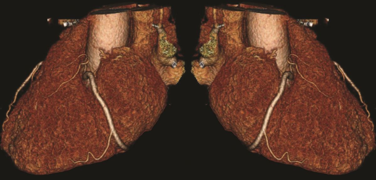 UniofOxford's tweet image. Researchers develop new early warning scan for heart attacks: po.st/r6uigg