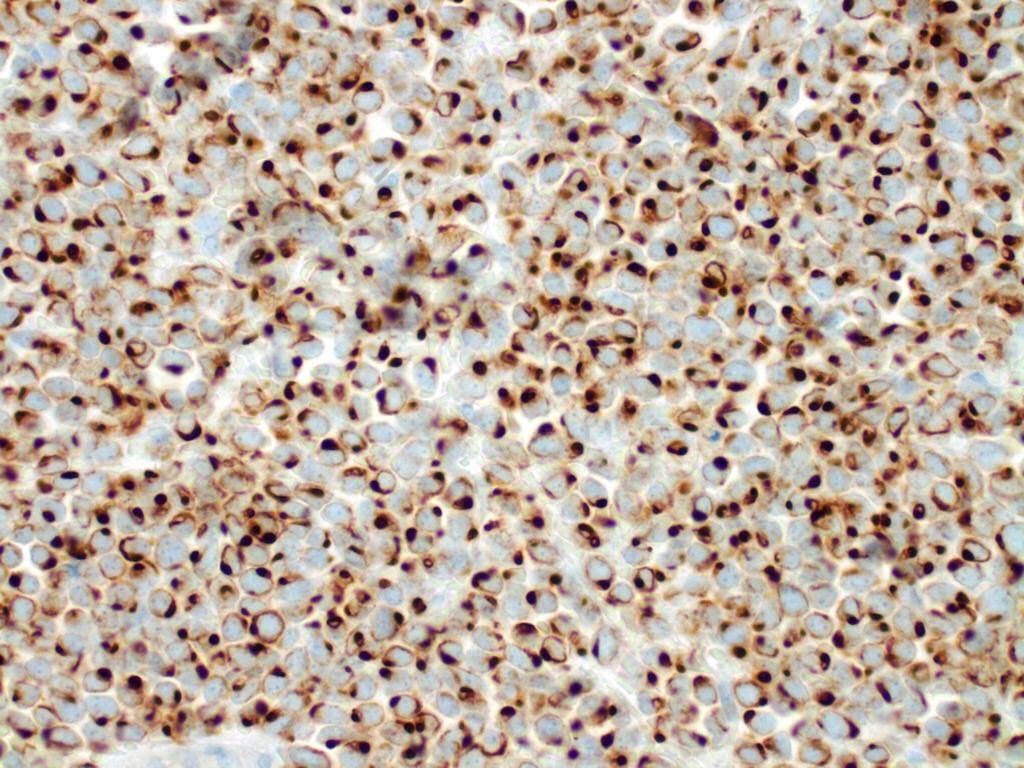 Kalyani Bambal (@kriyer68) on Twitter photo A nice Merkel cell carcinoma with nuclear molding high n:c and dotlike CK20 via <a href="/ASDPTweets/">American Society of Dermatopathology</a> #dermpath A nice Merkel cell carcinoma with nuclear molding high n:c and dotlike CK20 via <a href="/ASDPTweets/">American Society of Dermatopathology</a> #dermpath