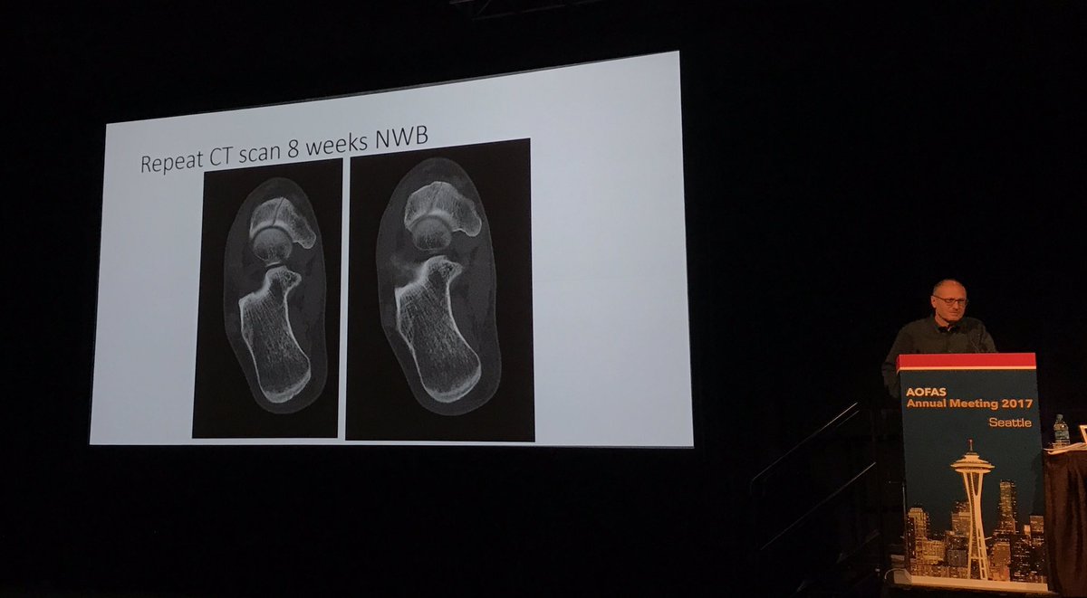 AlexisEDixonMD's tweet photo. Getting 95 years' combined experience from Hansen and Baxter on navicular stress fractures, which are challenging cases #AOFAS2017 https://t.co/FBoyepglod