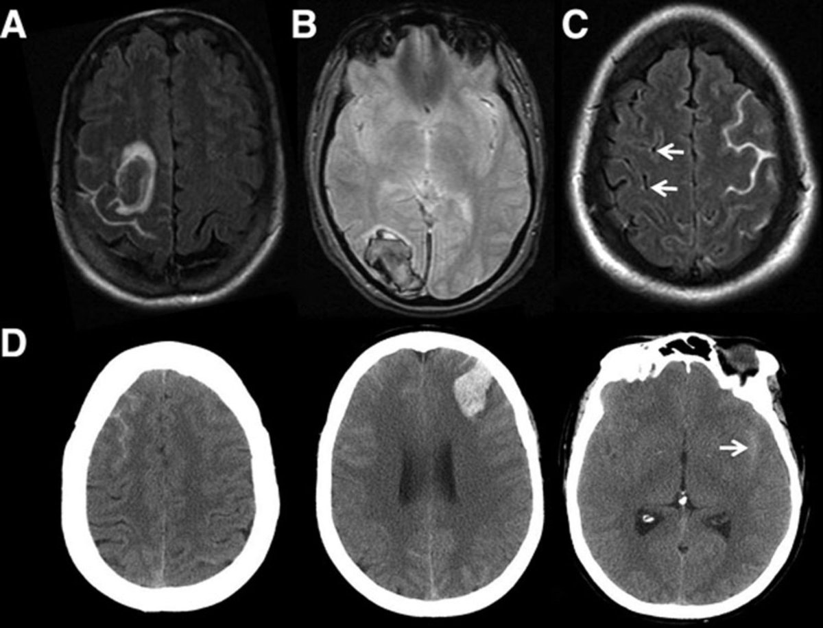 Stroke Aha Asa 出血性可逆性脳血管攣縮症候群 特徴と発症機序 T Co A5zyd2cshz T Co Rj8p7ozwo7 Twitter
