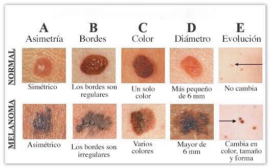 AGSOsuna's tweet photo. Disfruta del sol... pero con cabeza!
#pontealasombra #ponteprotector 
... y vigila tus lunares. Si cambian, consulta! https://t.co/MOk8VmaVF6