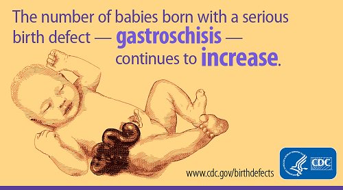 NBDPN's tweet photo. Gastroschisis affects the abdominal wall of babies. RT on July 30th to help us recognize #gastroschisis awareness day! @AverysAngels https://t.co/ubLGhoMvzR