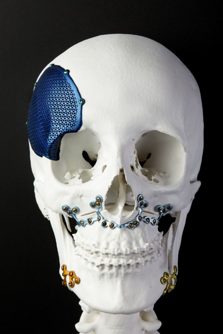GEAdditive's tweet photo. 3D-printing is transforming how Doctors perform complex reconstructive surgeries. #3dprinting #additivemanufacturing https://t.co/LRmhhdra8R https://t.co/QaZBUOsxTF